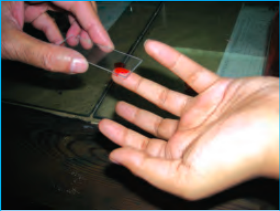 परीक्षण के लिए एक छोटी आयताकार कांच की स्लाइड पर मानव उंगली से रक्त लेना।