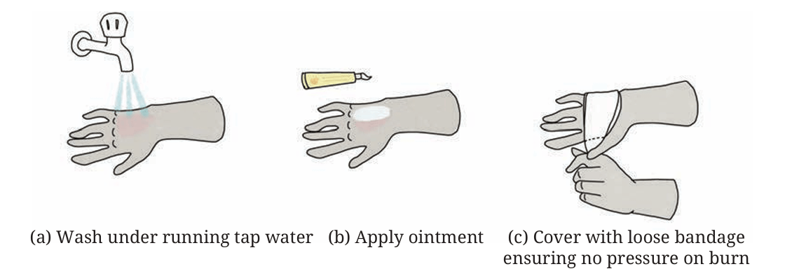 First-aid for burn
