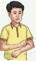 Chickenpox